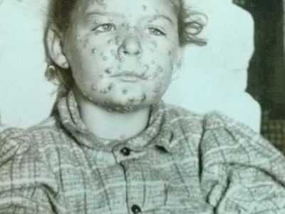 Smallpox-The Global Killer